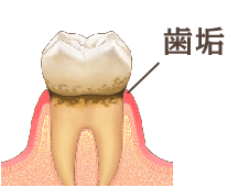 食べかすが残ってしまうと、その後歯垢となりたまっていきます。