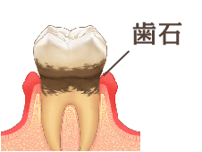 歯磨きでは取り除けない歯垢は、その後歯石になります。