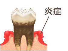 歯石を放っておくと菌が繁殖し、歯茎の炎症が起こります。